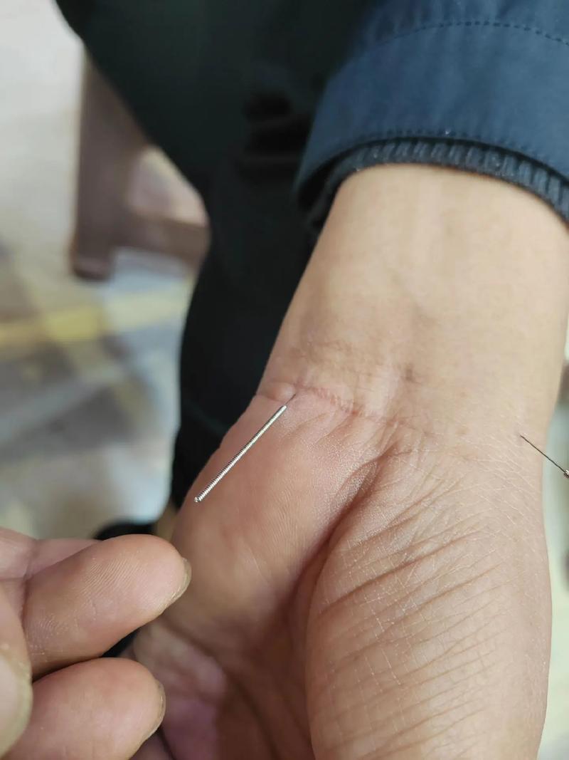 北京针灸到哪里最好