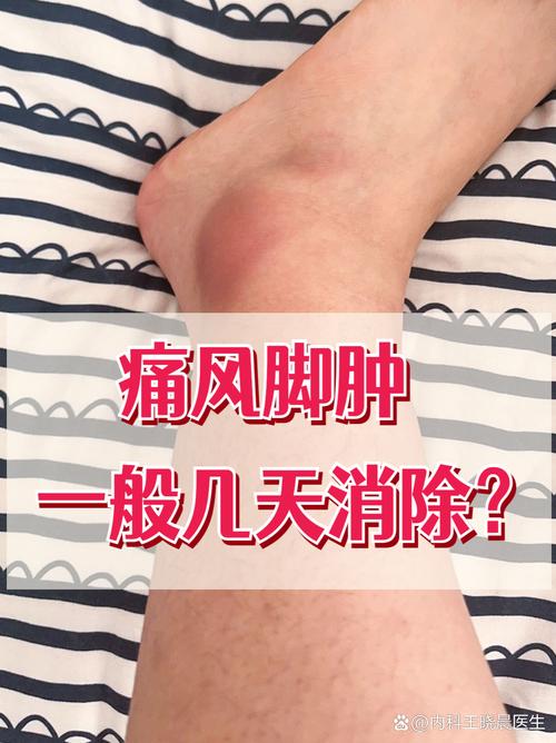 痛风关节肿大怎么消肿