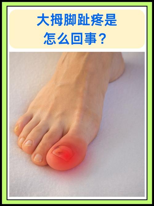 大脚趾关节痛是痛风吗