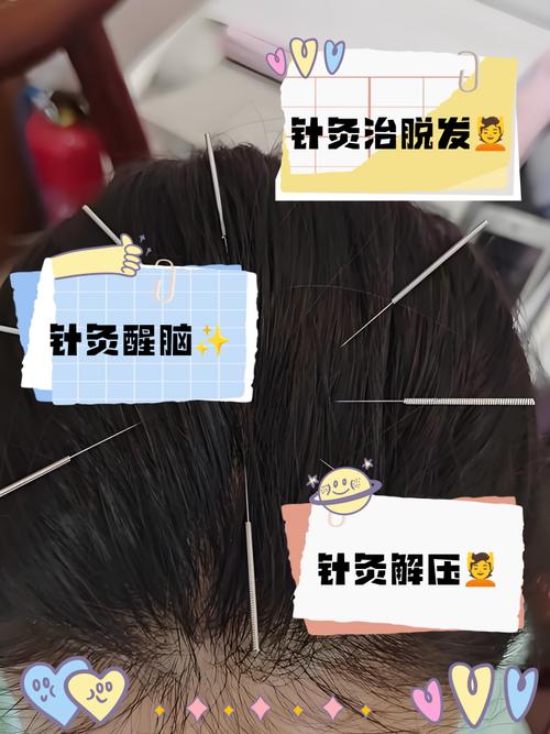 针灸额头有什么好处