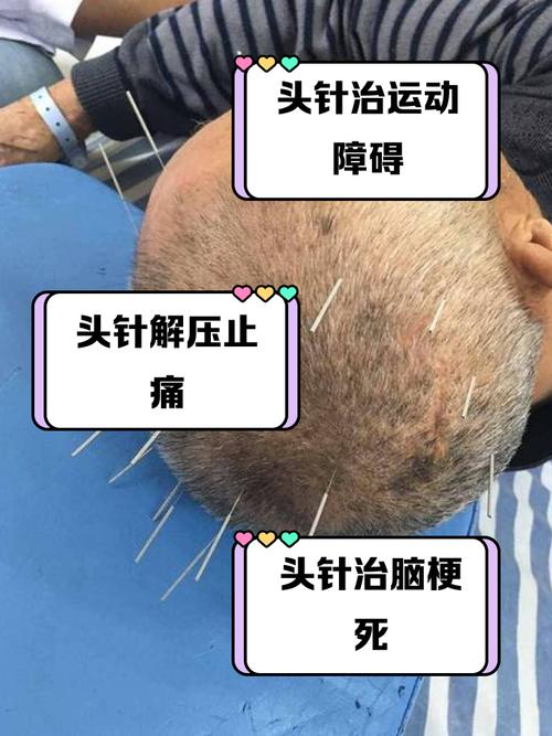 针灸额头有什么好处