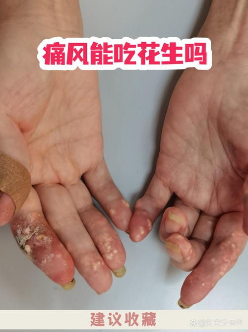 为什么痛风不能吃花生