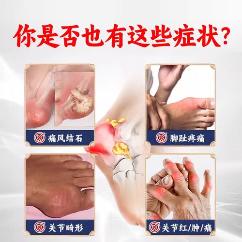 痛风性关节炎如何治疗