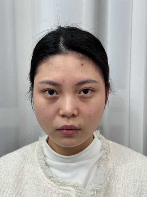 玻尿酸填充眼窝安全吗