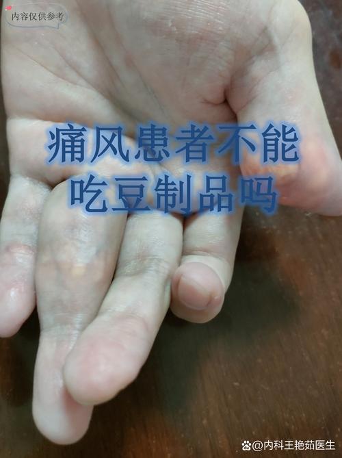 痛风患者能吃绿豆芽吗