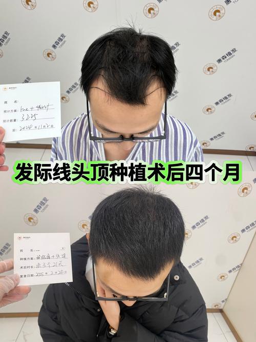 毛发移植海峡植发安全