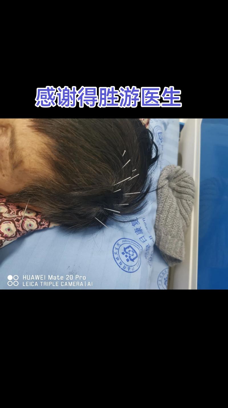 脑梗塞偏瘫针灸治疗