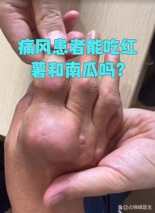 痛风病人可以吃红薯吗