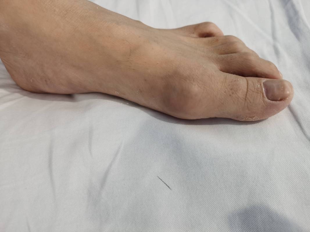 痛风的前期症状是什么