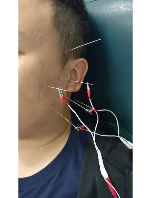 面瘫用电针还是针灸