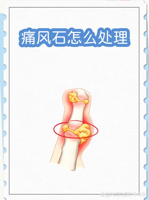 痛风一定会有痛风石吗
