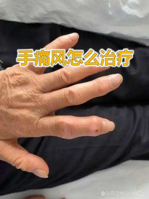 痛风性关节炎能治好吗