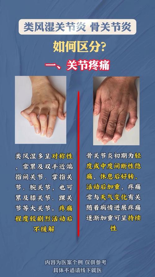 痛风与风湿有什么区别