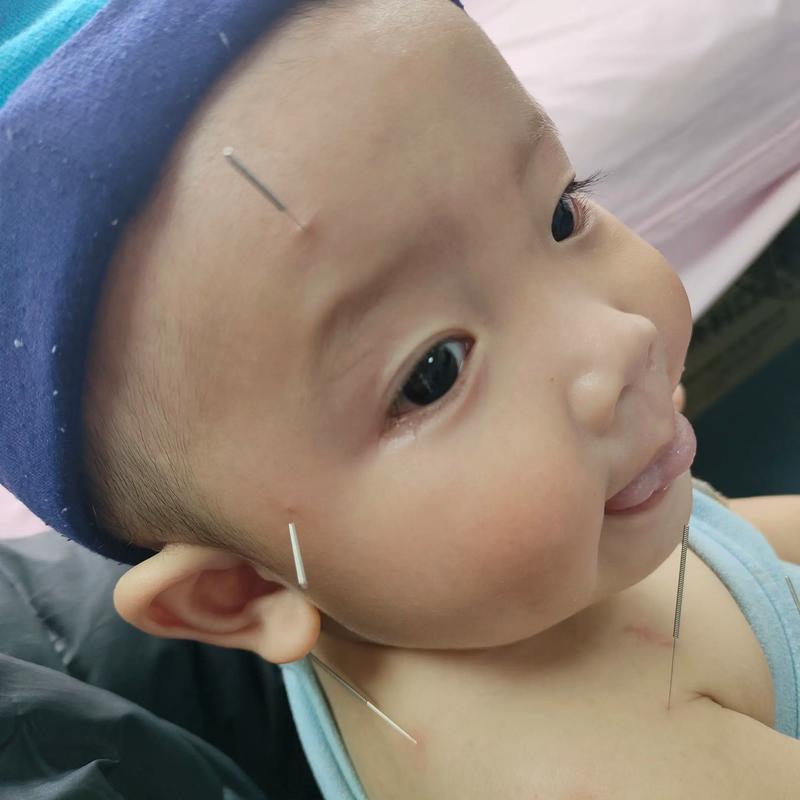 小孩面瘫能用针灸吗