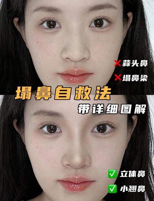 永久隆鼻最安全的方法