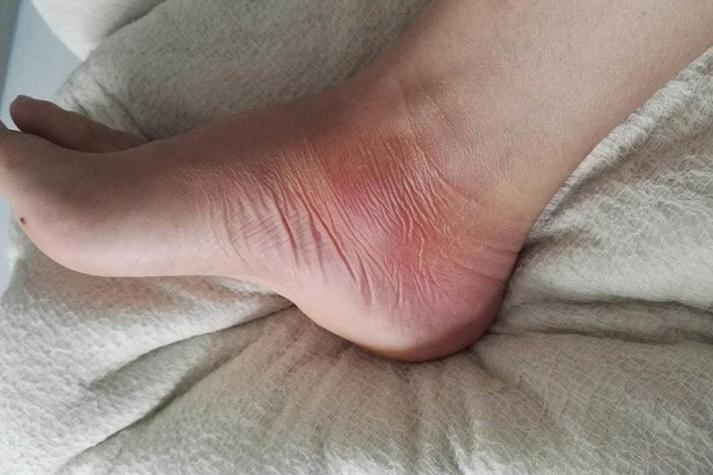 痛风的早期症状是什么