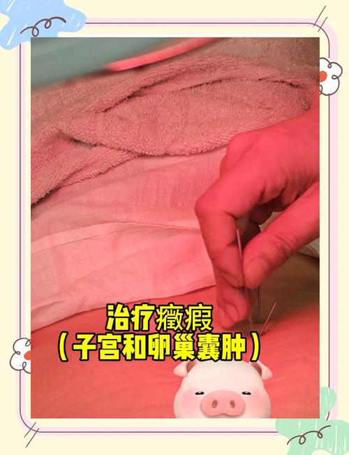 针灸治疗子宫肌瘤吗