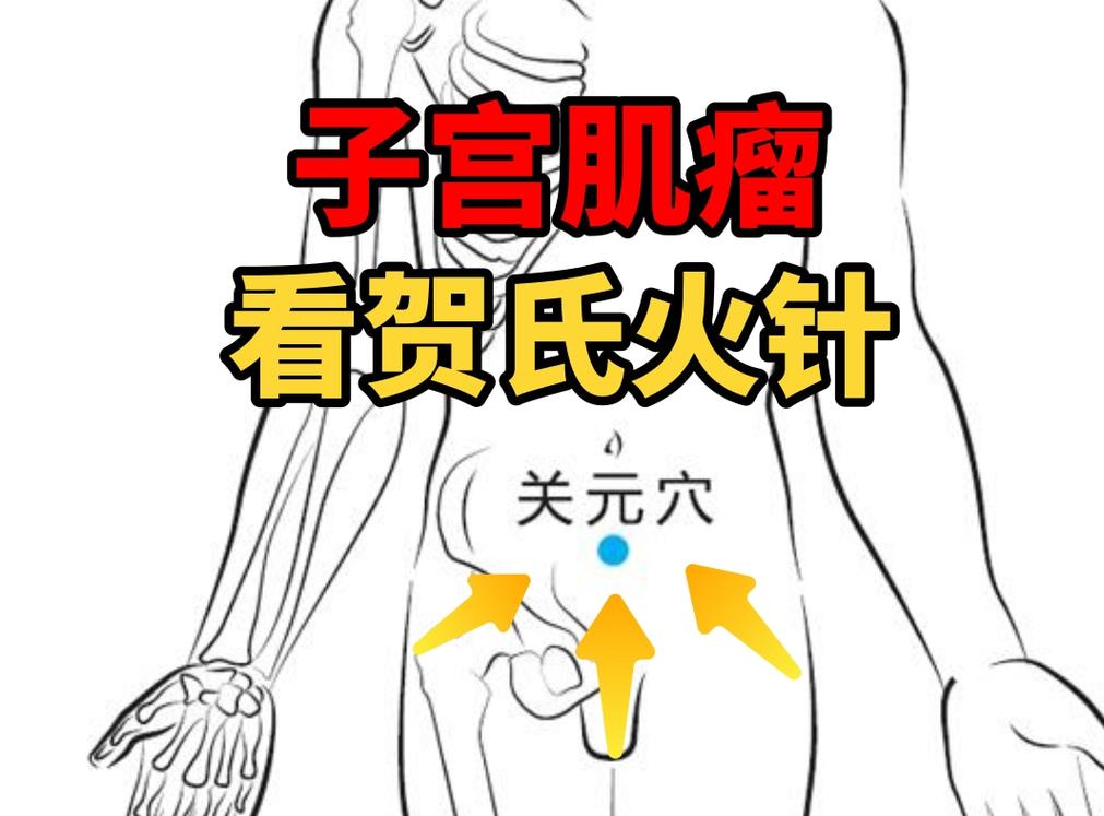 针灸治疗子宫肌瘤吗