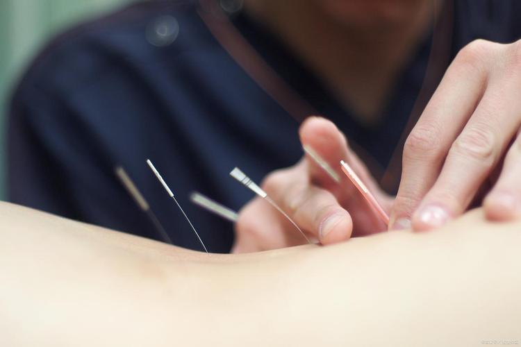 省中医 针灸 减肥