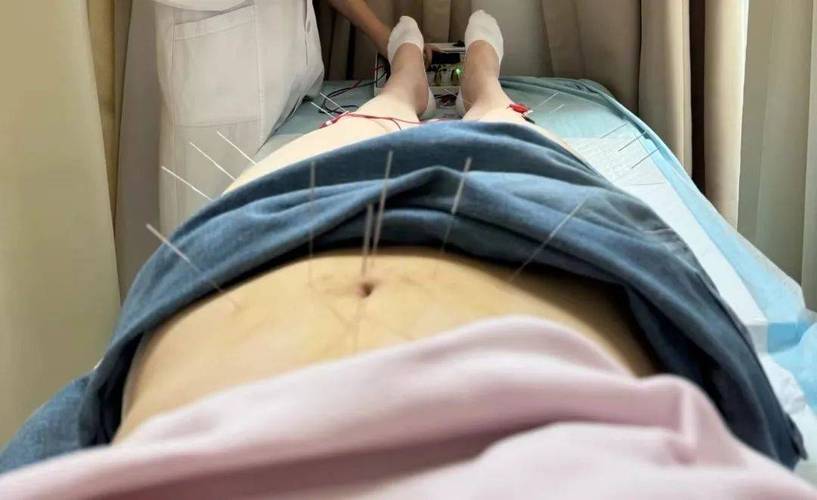 省中医 针灸 减肥