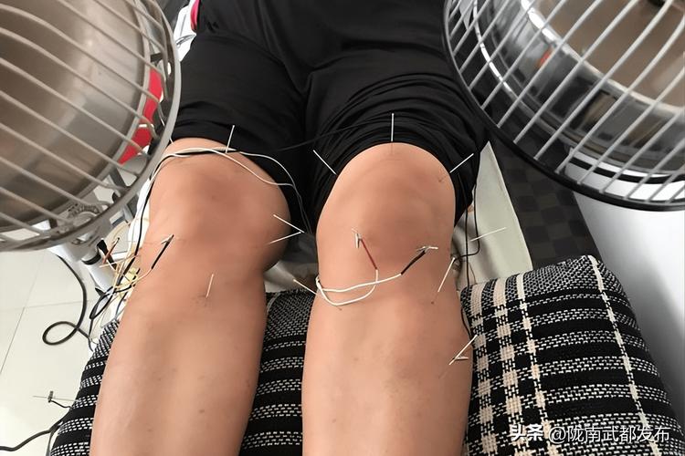 膝盖肌肉僵硬 针灸
