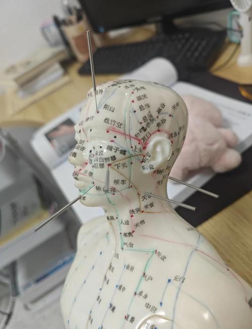面瘫 可以针灸 吗