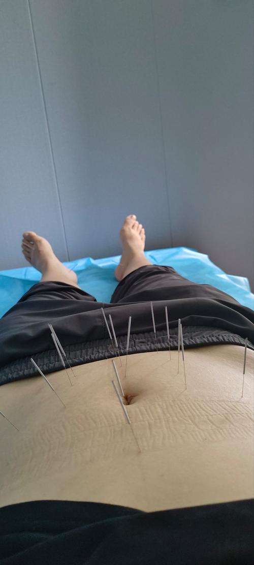 香山医院 针灸减肥