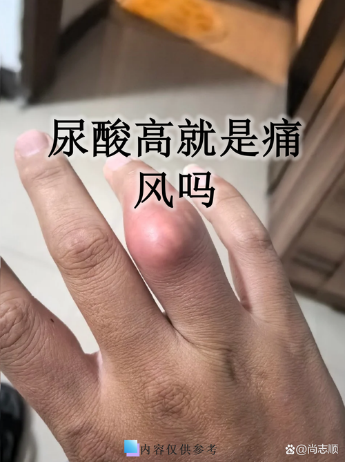 尿酸正常了还会痛风吗