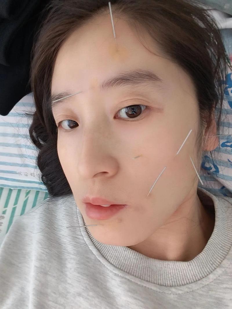 面瘫 针灸 眼下跳