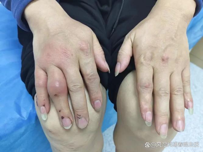 痛风石是软的还是硬的