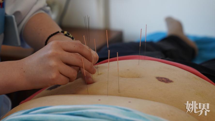 针灸减肥 北京医院