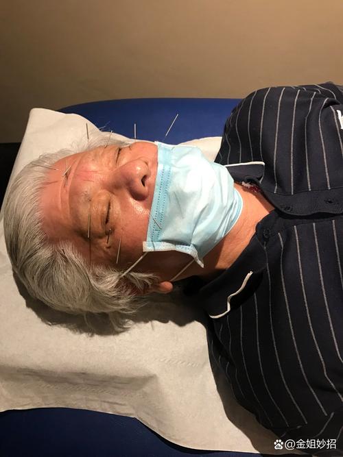 哈尔滨针灸治疗近视