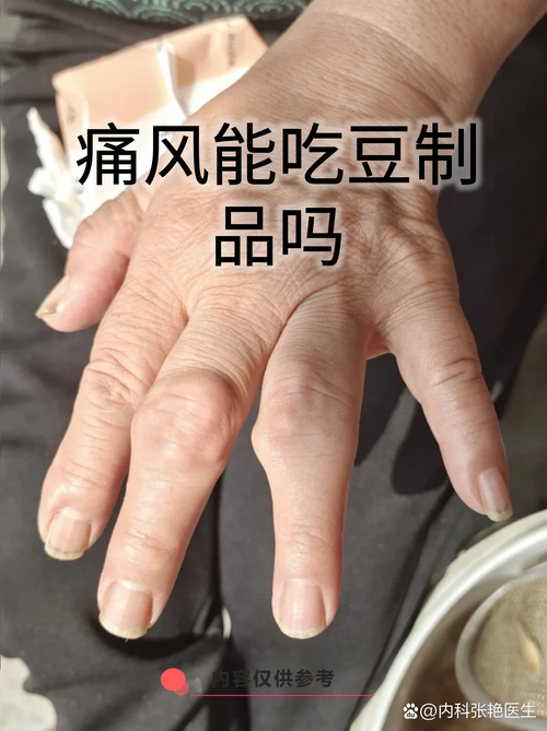 黄豆痛风患者可以吃吗