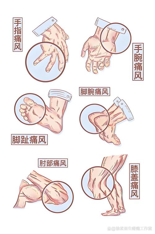 痛风发作如何缓解疼痛