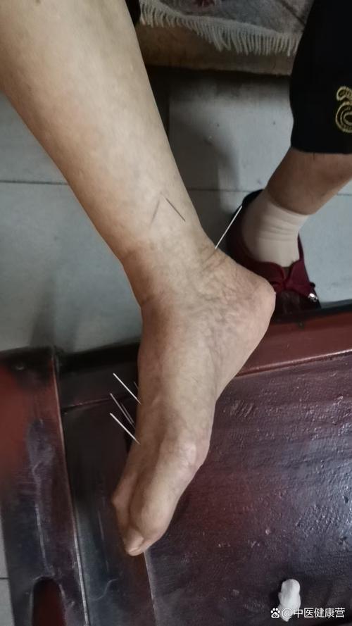 针灸治疗腓肠肌痉挛