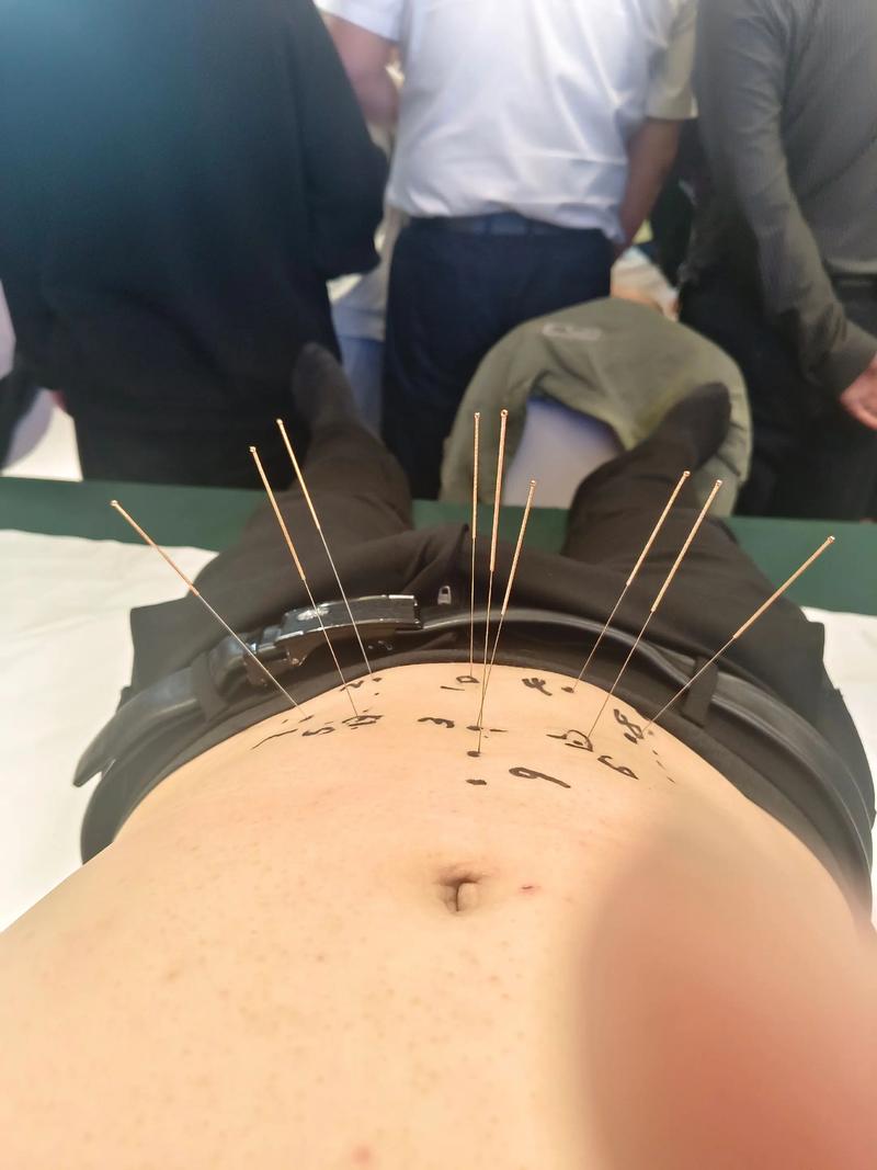 北京天伦医院 针灸