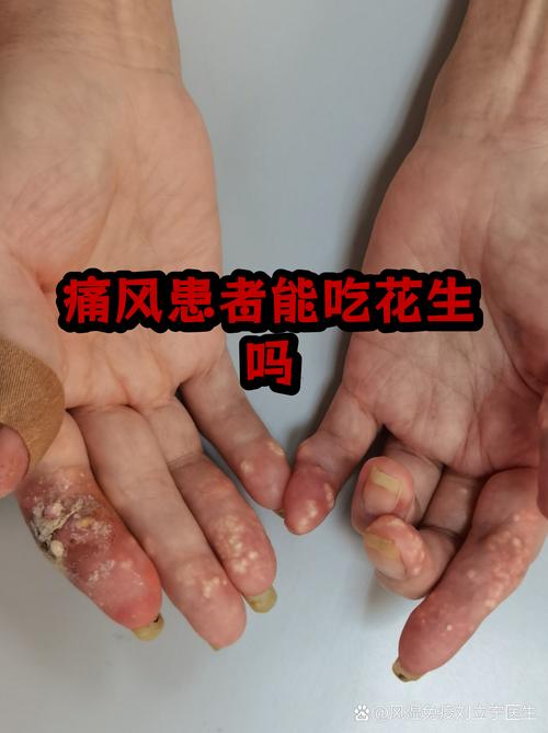 痛风病人可以吃花生吗