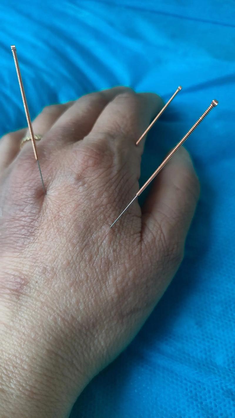 针灸治疗肩周炎心得