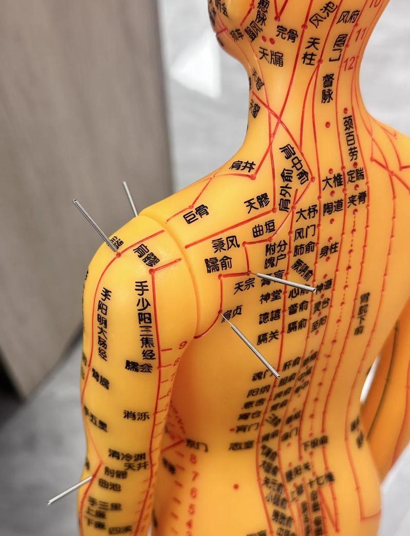 针灸可以治疗肩周炎