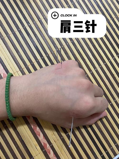 针灸可以治疗肩周炎