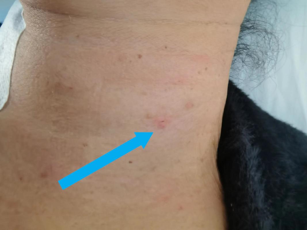 针灸治疗甲状腺囊肿