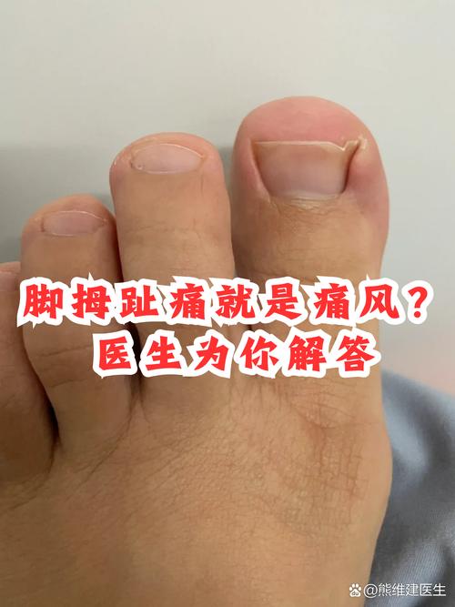 脚大拇指痛风怎么治疗