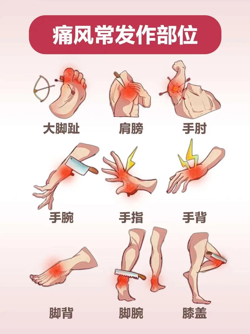痛风发作如何快速止痛