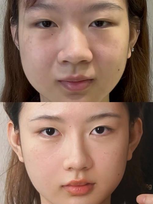 玻尿酸填充鼻子安全吗