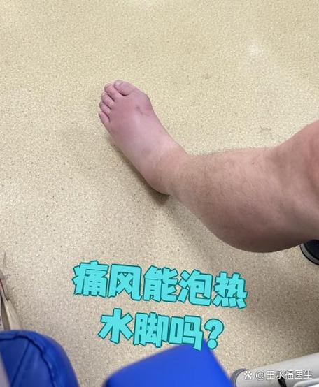 痛风发作期能泡温泉吗