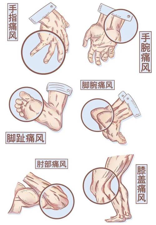 痛风的疼痛感是怎样的