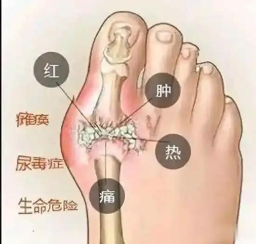 痛风的疼痛感是怎样的
