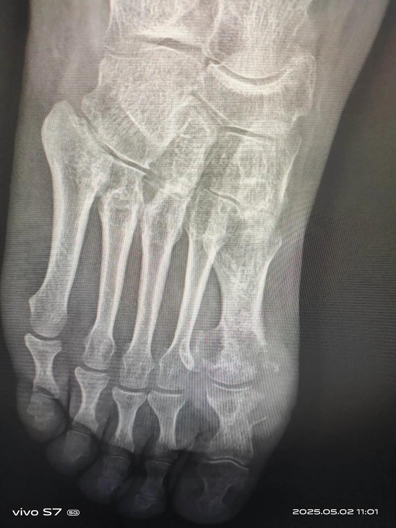 右脚大拇指痛风怎么办