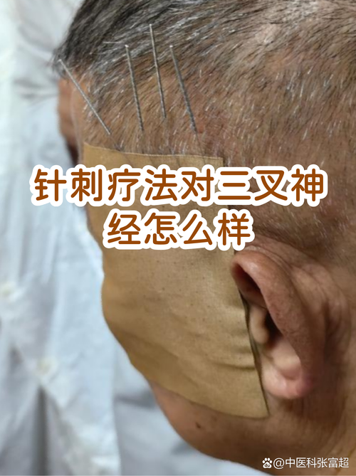 三叉神经痛怎么针灸