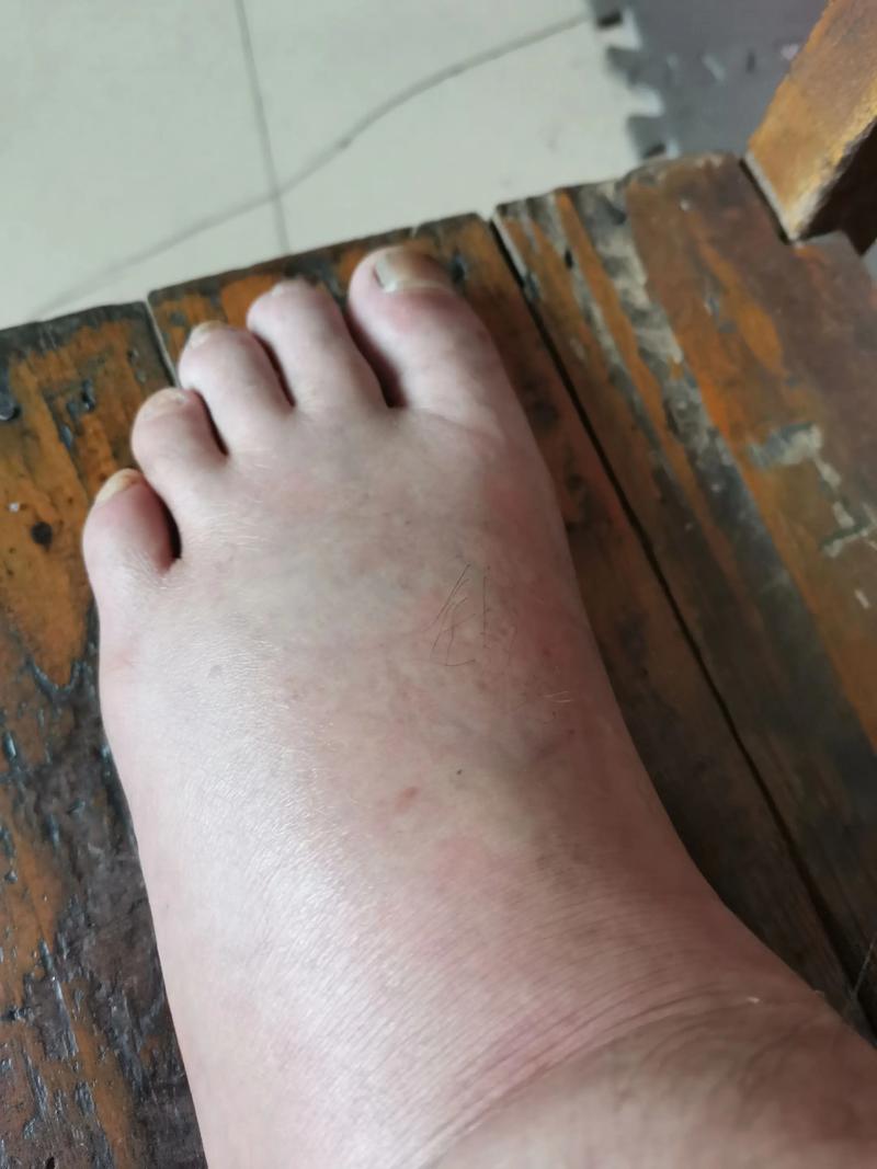 痛风脚肿多久才能消肿